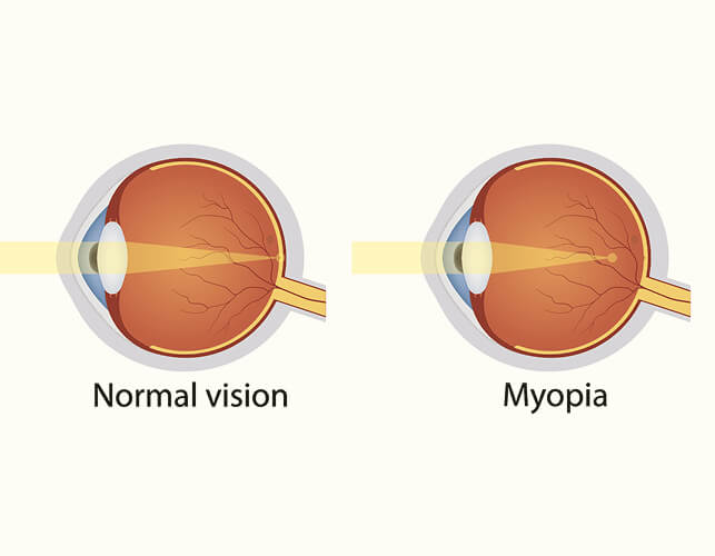 Myopia two